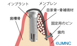 GBR法(骨誘導再生法)