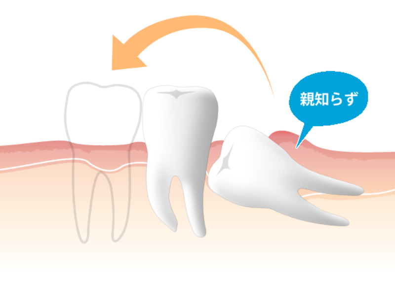 ご自身の歯を活かす治療「歯の移植（自家歯牙移植）」