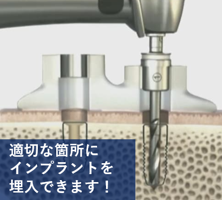 サージカルガイドを用いた精密な埋入手術(ガイデッドサージェリー)