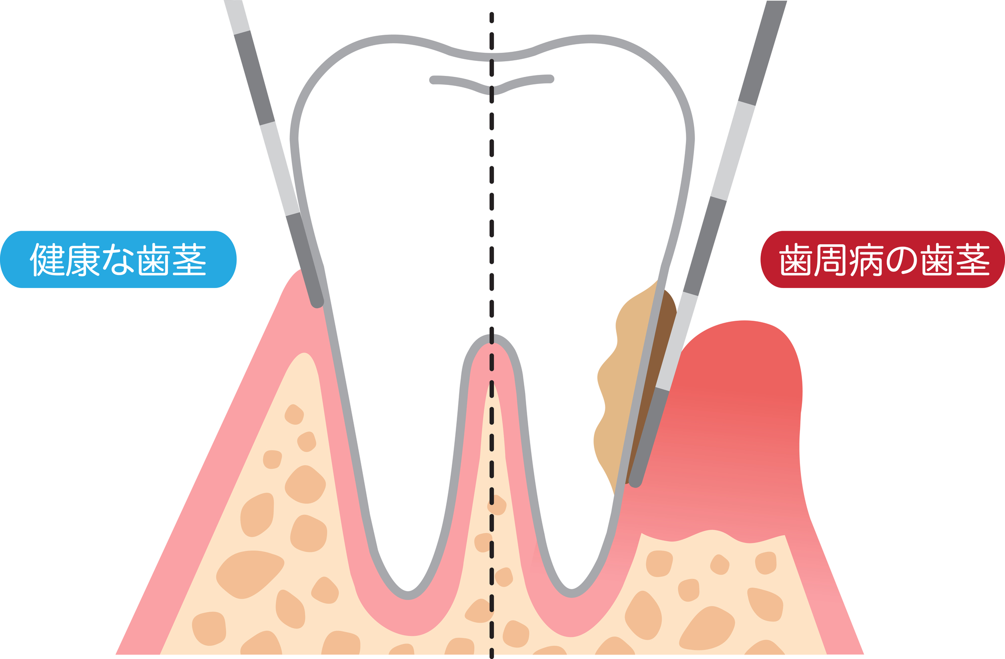 歯ぐきの出血や痛みがなくても定期検診を