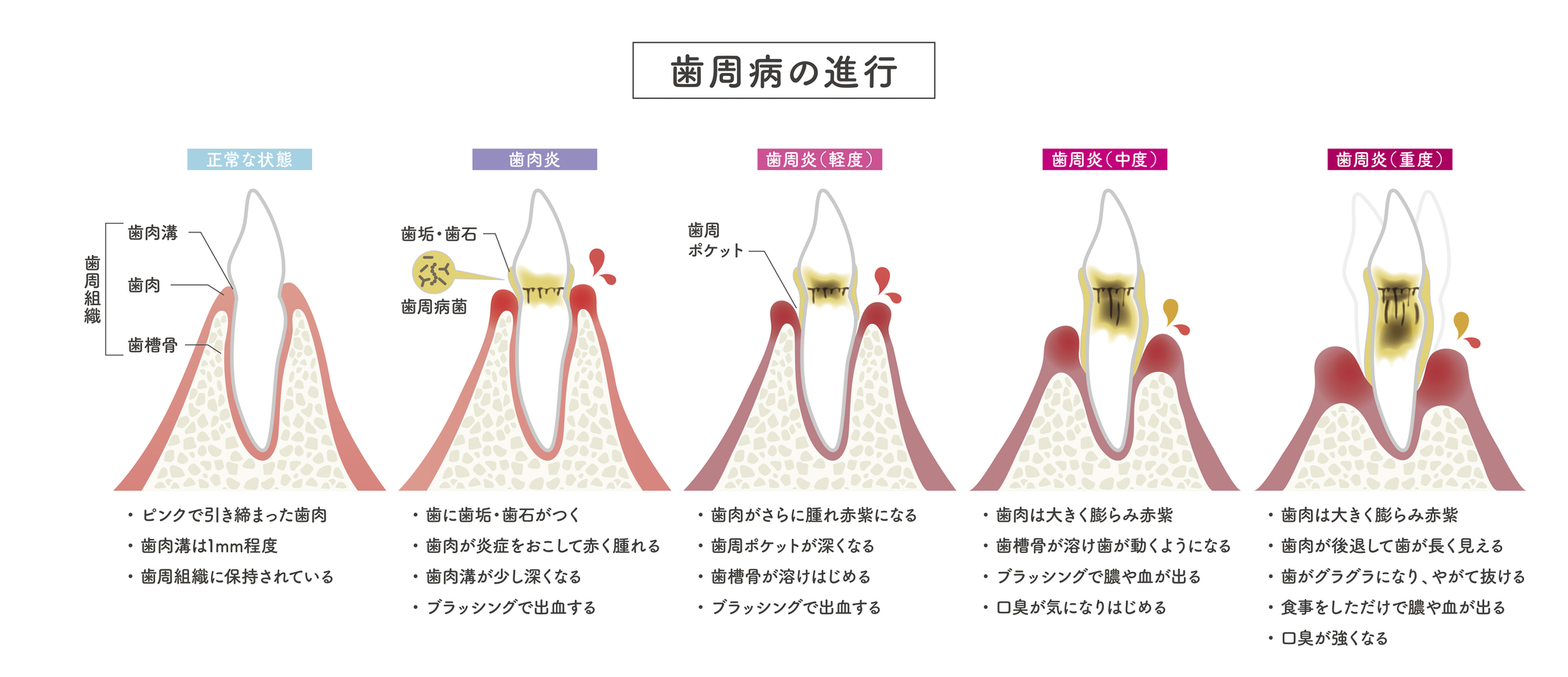 歯がぐらついている歯周病の対応も可能です