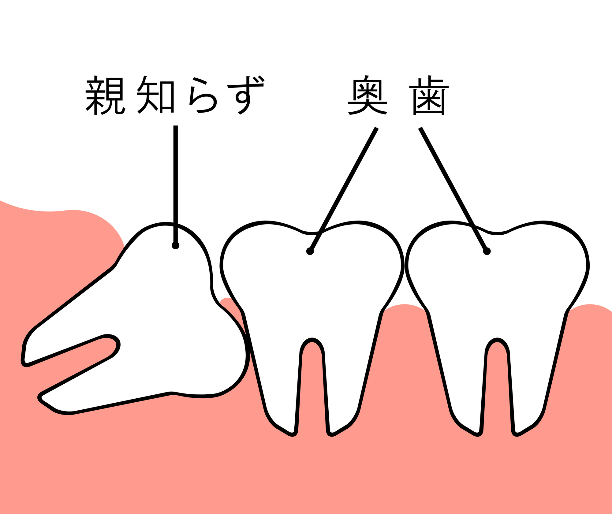 親知らずは抜くべき？それとも抜かなくても大丈夫？