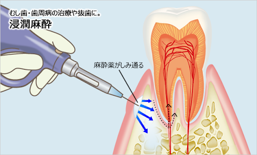 電動麻酔による痛みの軽減